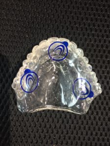implant-concierge-implant-sample