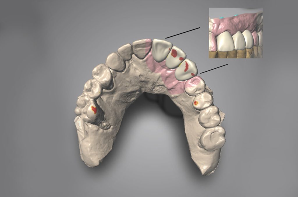 Implant Concierge Software de planificación 3D Virtual Wax Up Odontología restauradora de implantes