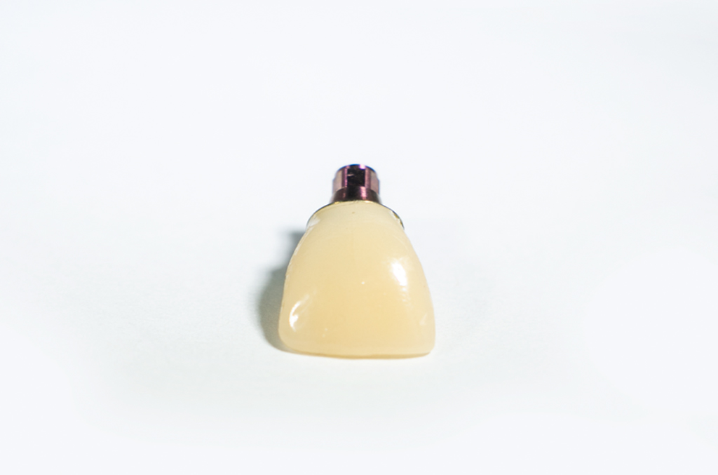 Full Contour Screw Retained PMMA Crown Full Contour Screw Retained PMMA Crown Provisional Temporary