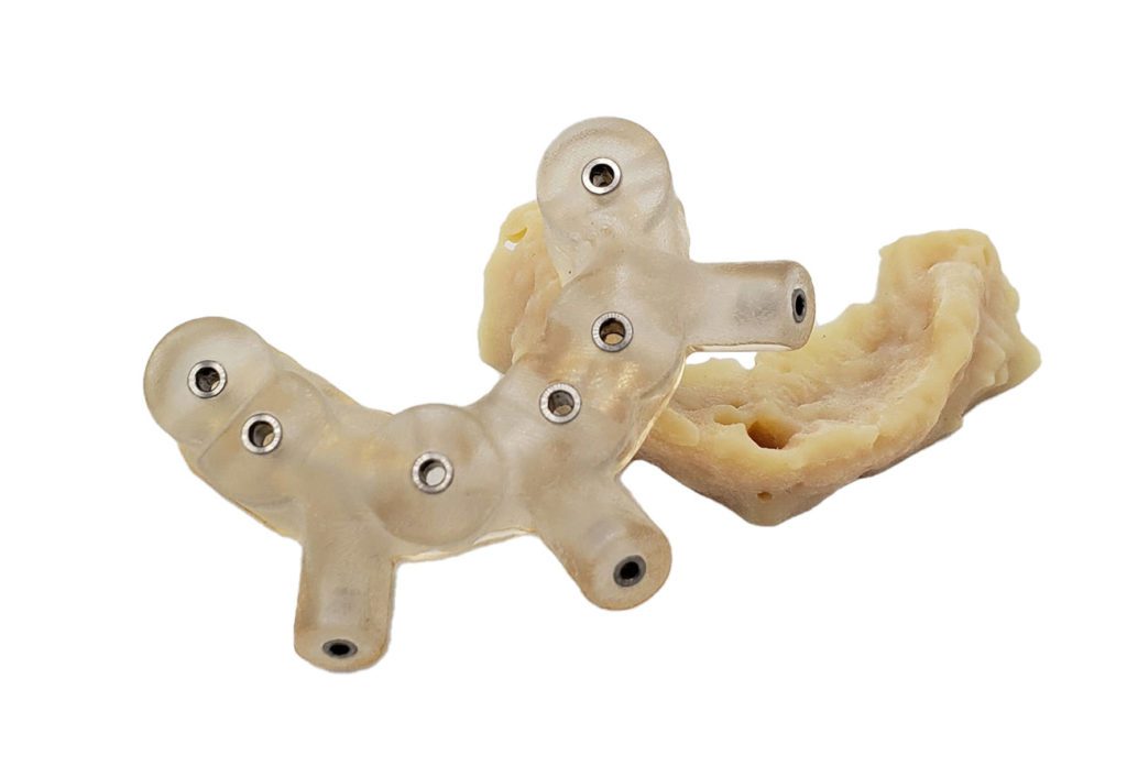 El alambique óseo para la cirugía de implantes guía a los dentistas