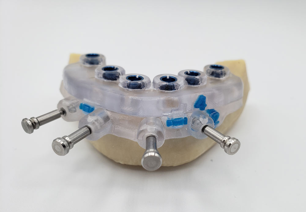 Gestapeltes BRG-Modell von Implant Concierge für die geführte Chirurgie