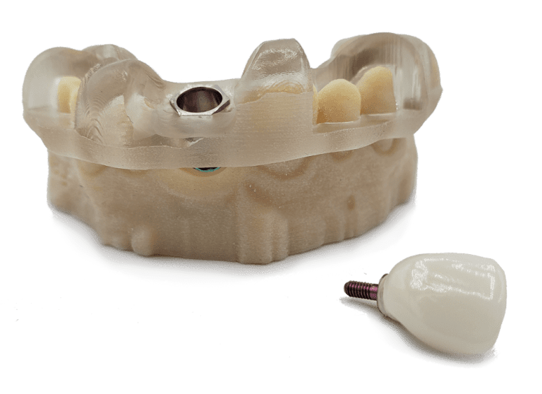 Implant Concierge Surgical Guides for Dental Implants