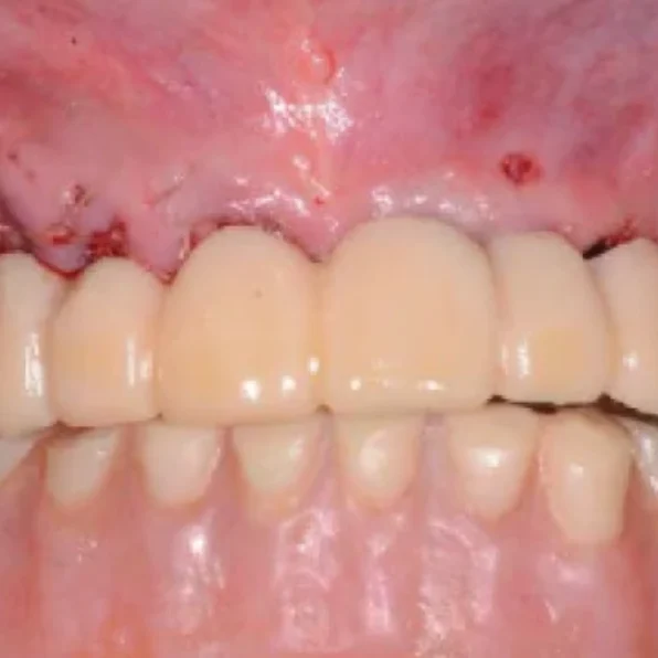 イミディエート インプラントロジー 即時配置のためのデジタル精度